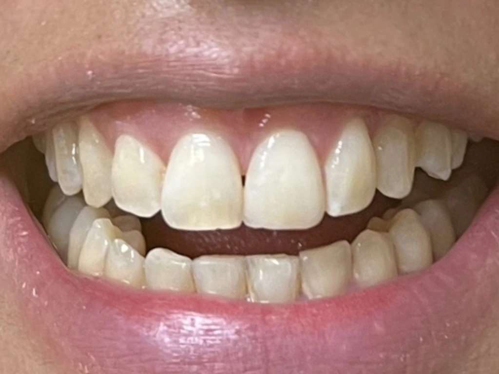 Cierre de diastema con composite de alta estética en White Point Dental Studio