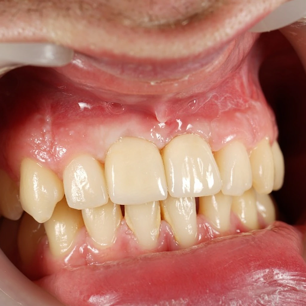 Rehabilitación con implante dental y corona estética en White Point Dental Studio