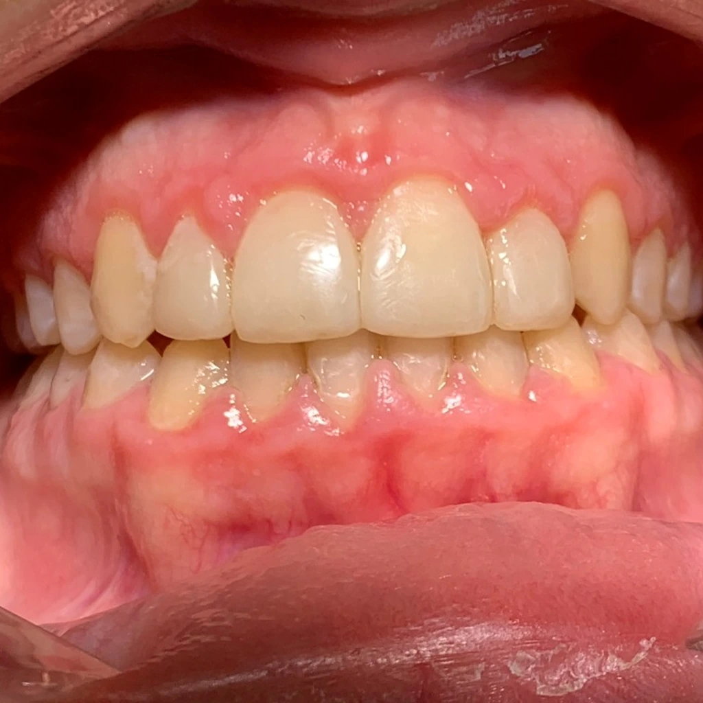 Sonrisa armónica tras ortodoncia interceptiva, recontorneado gingival y diseño digital en White Point Dental Studio