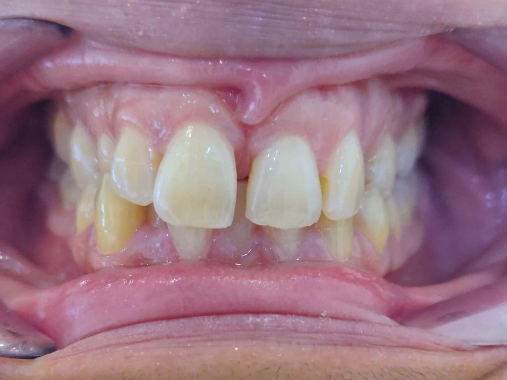 Diastema y separación dental antes del tratamiento