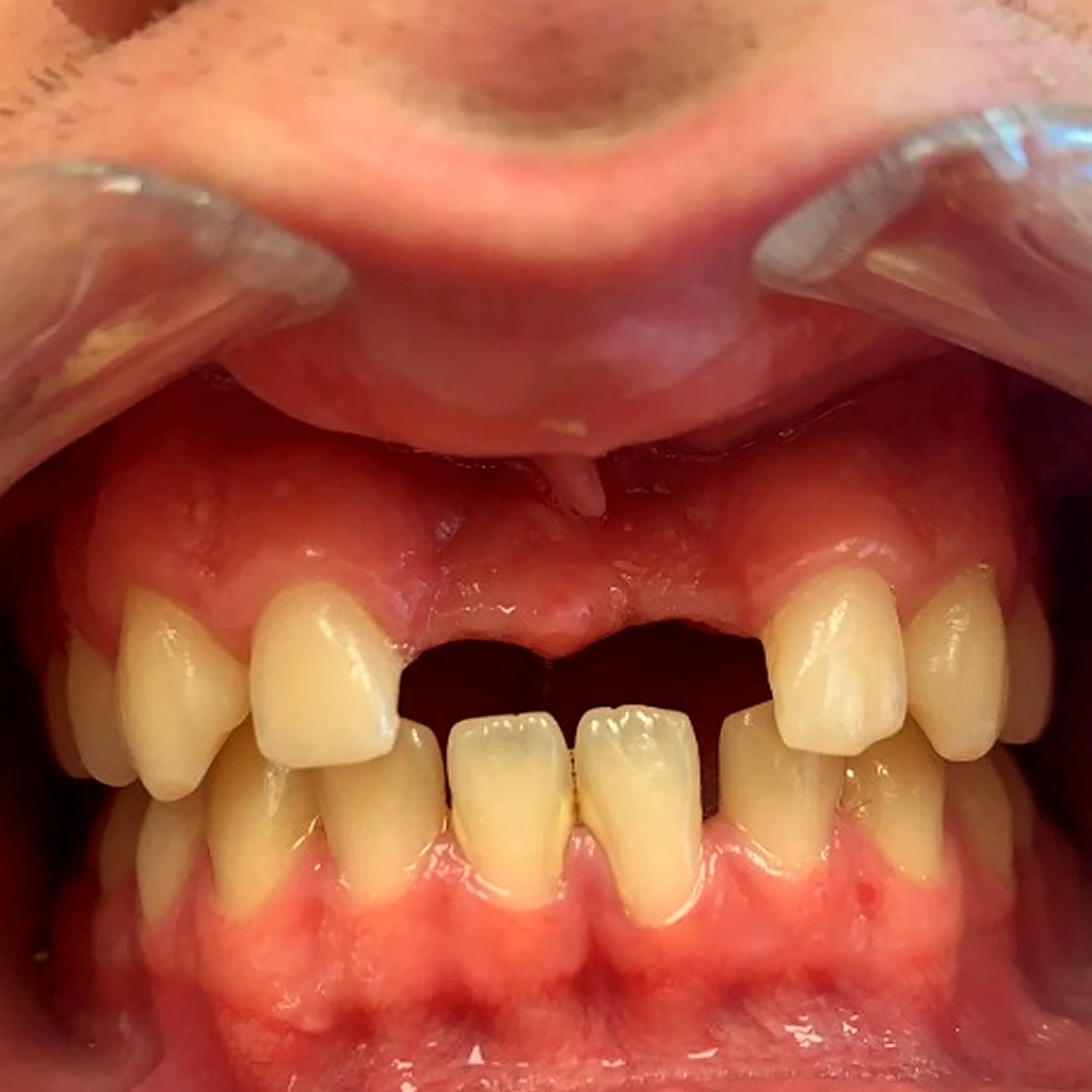 Pérdida de pieza dental antes del implante